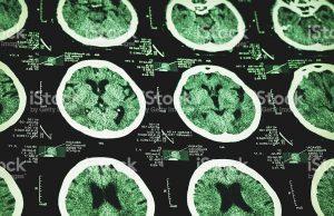 braininjuries