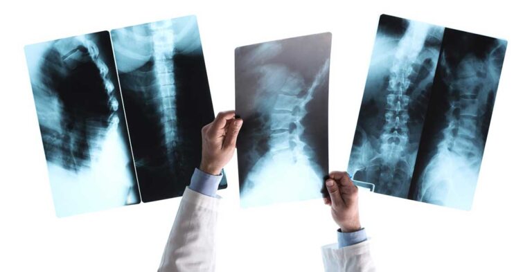 What are the Causes of Spinal Cord Injuries?