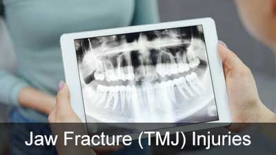 Jaw Fracture or TMJ