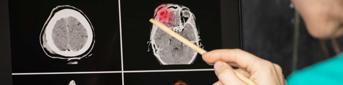 A surgeon looking at a scan for brain trauma following an ebike injury